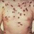 Tipos de cáncer de piel - Manchas de melanoma y cáncer de piel Carcinoma