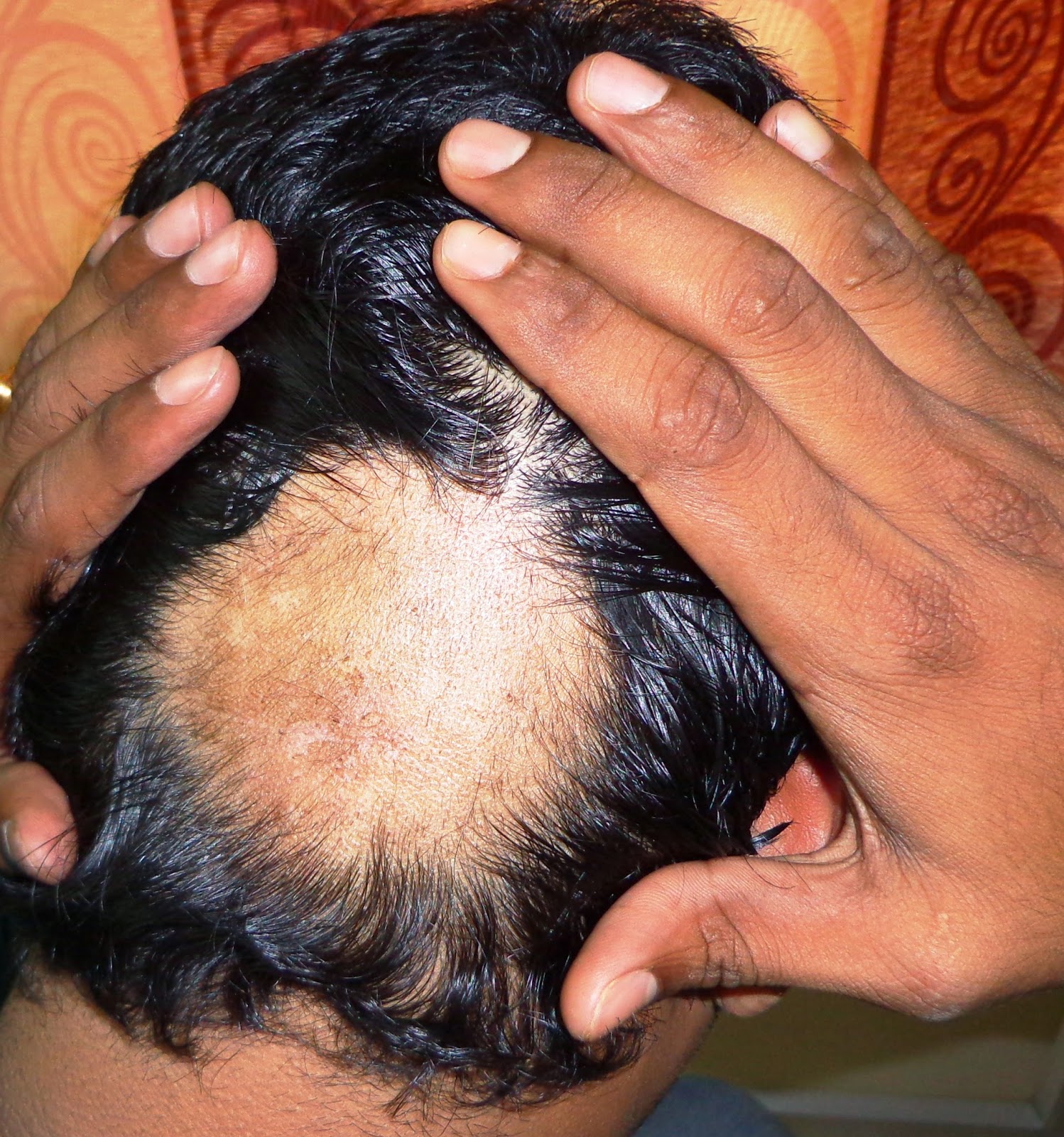  specialist doctor for alopecia areata at chennai, tamilnadu, hospital 9443054168