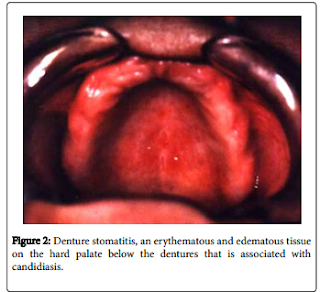 Denture-Related Stomatitis