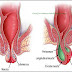 Obat Wasir Setelah Melahirkan thumbnail