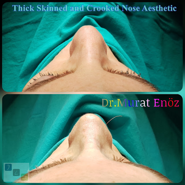 Crooked Nose Aesthetic Surgery For Female Patient Micromoto Assisted Rhinoplasty Istanbul