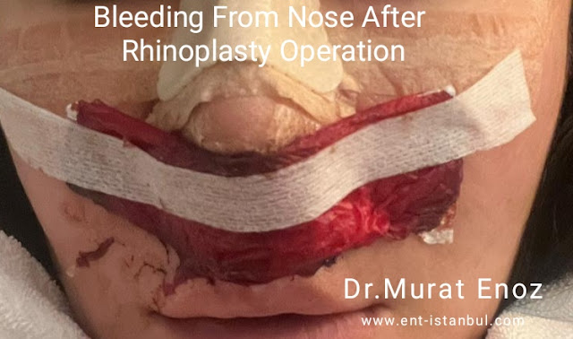 Bleeding After Rhinoplasty
