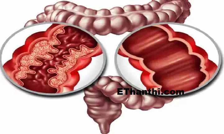 குடல் புற்றுநோய் பற்றி அறிந்து கொள்ள வேண்டிய முக்கிய அறிகுறிகள் !