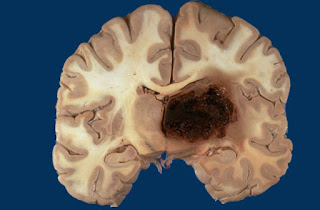 Duret hemorrhage Definition, Symptoms, Causes, Treatment