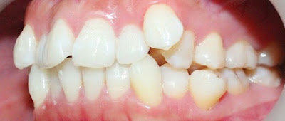 Tác hại của răng lệch lạc như thế nào?