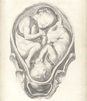 twins  childbirth