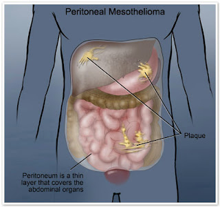 Mesothelioma - When That Stomach Ache Means More Than A Bad Borrito