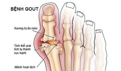 Phá hủy khớp xương là một trong những tai biến của bệnh gout