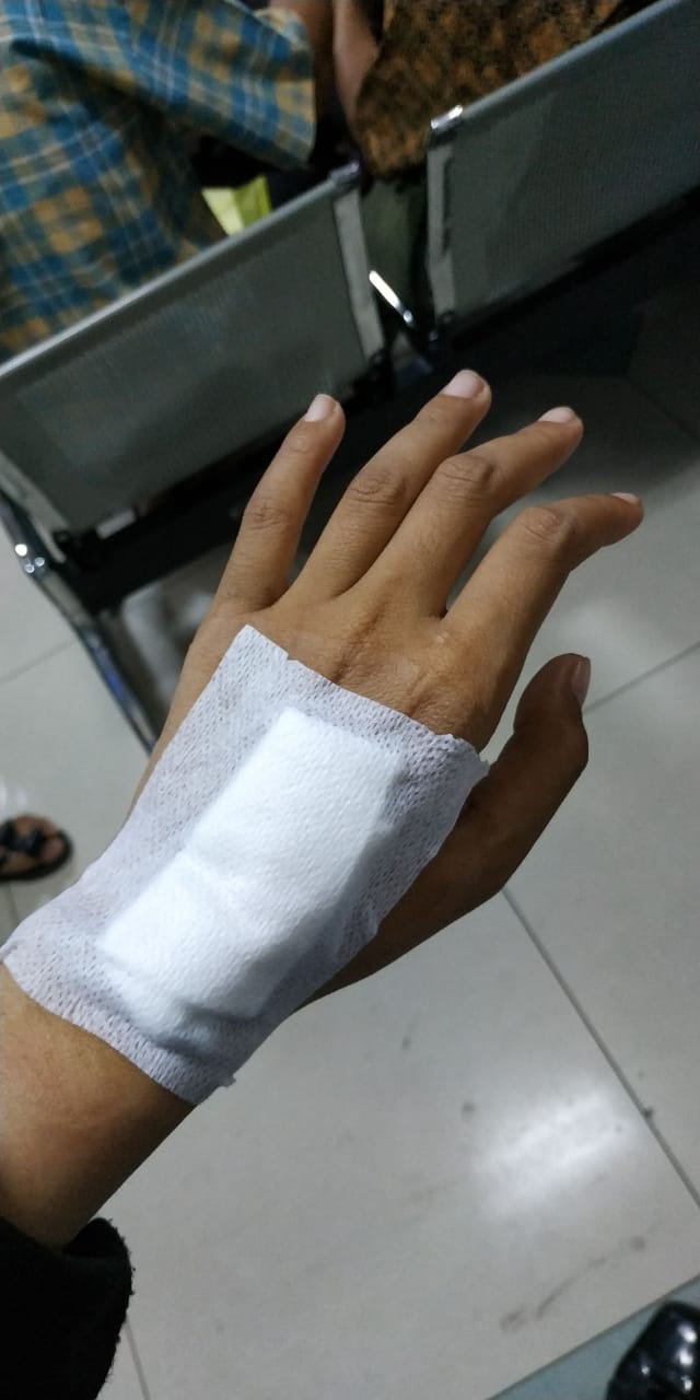 Pengalaman Operasi Pengangkatan Keloid Di  Tangan  Kiri Bius