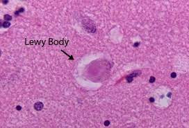 What Is Lewy Body Dementia Causes, Symptoms,?