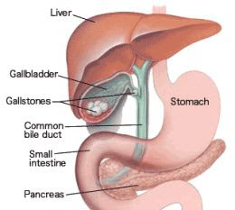 Nursing Care Plan Cholelithiasis Nursing Diagnosis