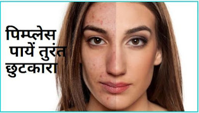How to get rid of pimples and acne in Hindi-by anmolhealthblog