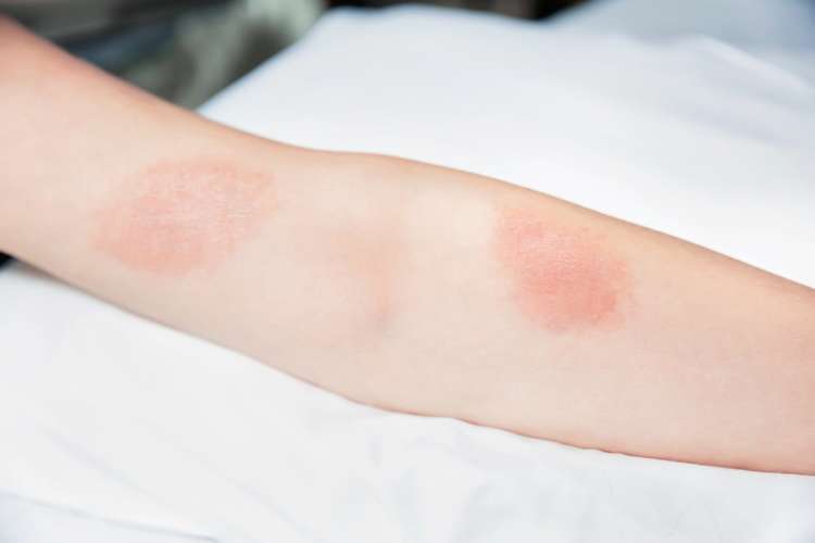 Kenali 5 Gejala Alergi Pada  Anak dengan Kulit  Sensitif 