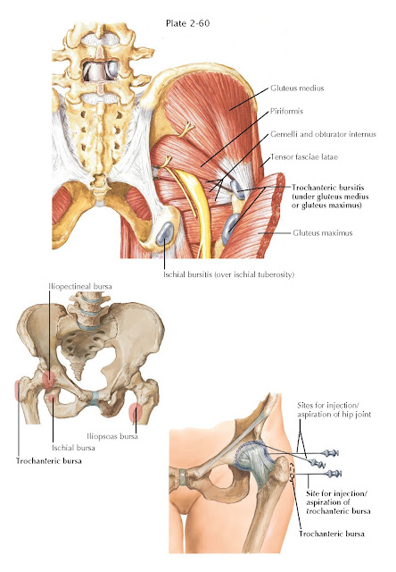 TROCHANTERIC BURSITIS