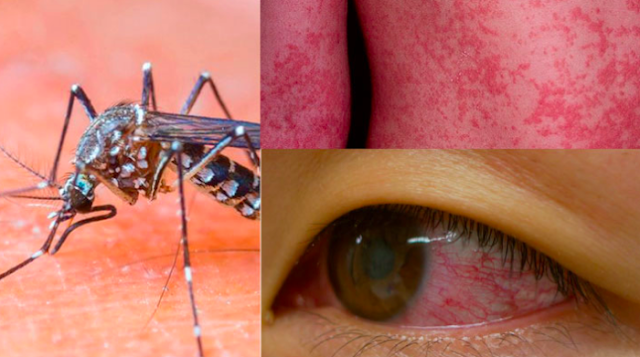Kenali Gejala Orang Yang Terkena infeksi Virus Zika