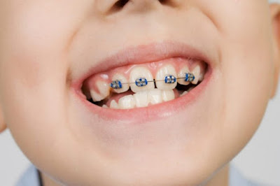 Quy trình niềng răng trẻ em 
