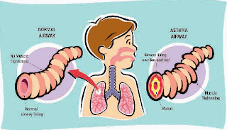 childhood obesity asthma