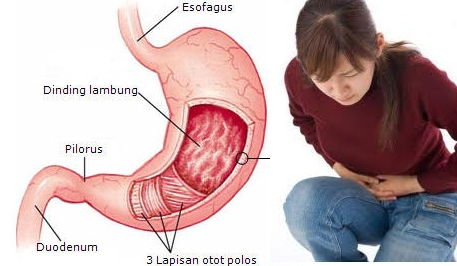 Pantangan Penyakit Asam Lambung 