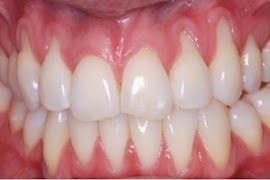 15. Home Remedies For Receding Gums