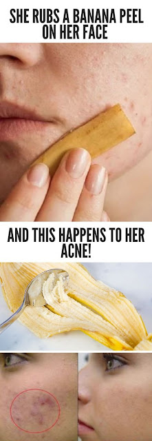 She Rubs A Banana Peel On Her Face And This Happens To Her Acne!