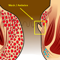 Pengidap Penyakit Wasir & Ambeyen