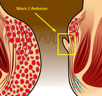 Pengidap Penyakit Wasir & Ambeyen