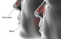 mimisan, epistaksis @Blog Keperawatan