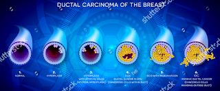 Stages of ductal carcinoma of breast cancer