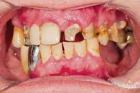 दांतों के रोग में खजूर के सेवन से लाभ