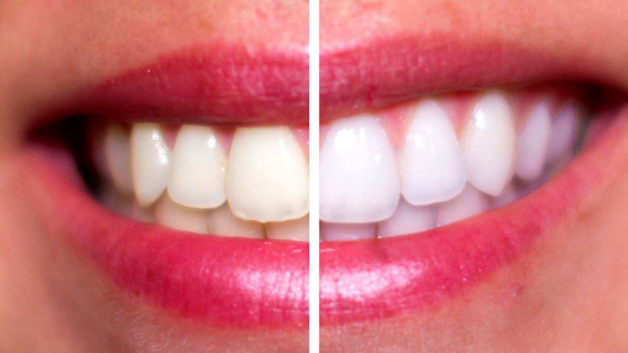 Professional Teeth Whitening Prices