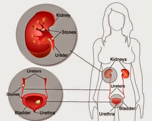 Obat Herbal Batu Ginjal Tanpa Operasi