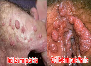 obat kutil di dalam vagina