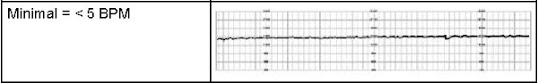 Minimal Fetal Heart Rate Monitoring Strip