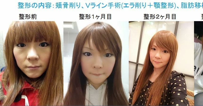 アジア最初の輪郭専門病院 韓国id美容外科です Id Hospital Review 日本人整形ビフォーアフター 頬骨削り Vライン手術 アジア最初の輪郭専門病院 韓国id美容外科です Id Hospital Review 日本人整形ビフォーアフター 頬骨削り Vライン手術