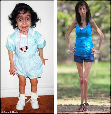 Lizzie Velasquez, Wanita Menginspirasi Yang Dulunya Sering Dibully