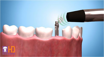 Đặt Implant tức thì sau nhổ răng