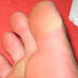 Causes of Yellow Feet