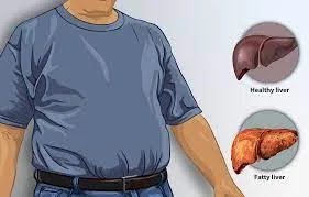 the liver. Illustration of a guy with fatty liver