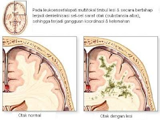 Leukoensefalopati