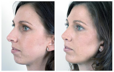 Chin Implant