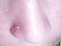 Keloid piercing