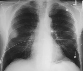 Bronchial-adenoma-x-ray