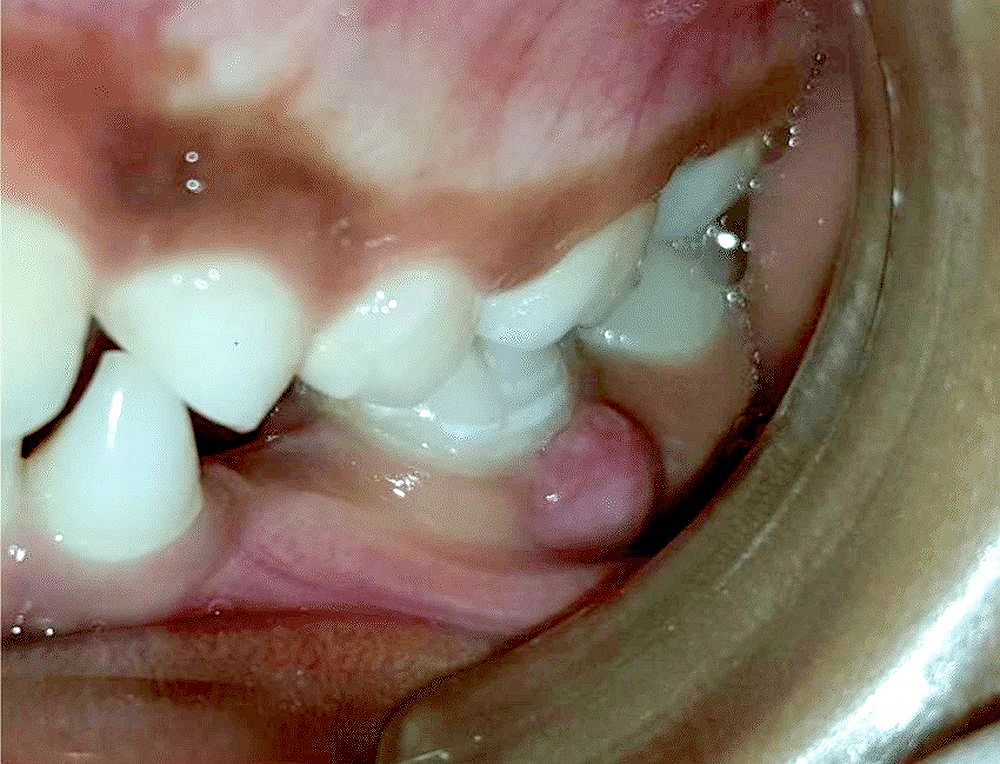 Infección Odontogénica