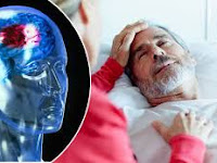 Bagaimana Cara Cepat Mengatasi Stroke Ringan?