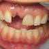 Trồng răng giả thời điểm nào thích hợp nhất?