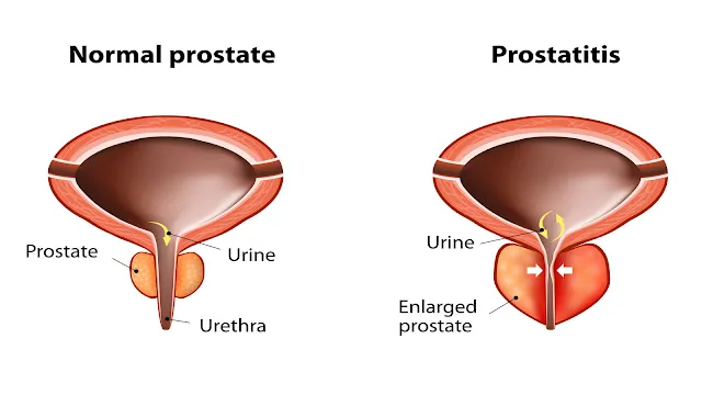 prostate enlargement