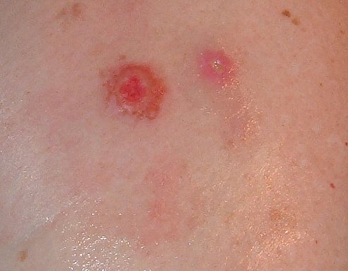 spider bites pictures on humans. spider bites pictures on