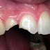 Vì sao răng bị mẻ?