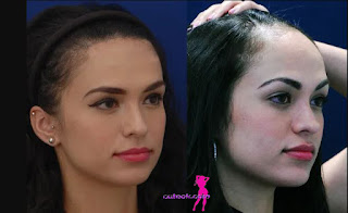 plastic surgery forehead reduction