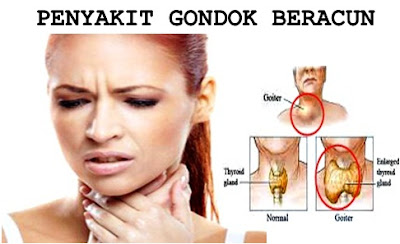 Obat Untuk Penyakit Gondok Beracun Tradisional Alami